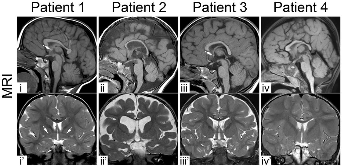 MRI images of atypical cortical folding