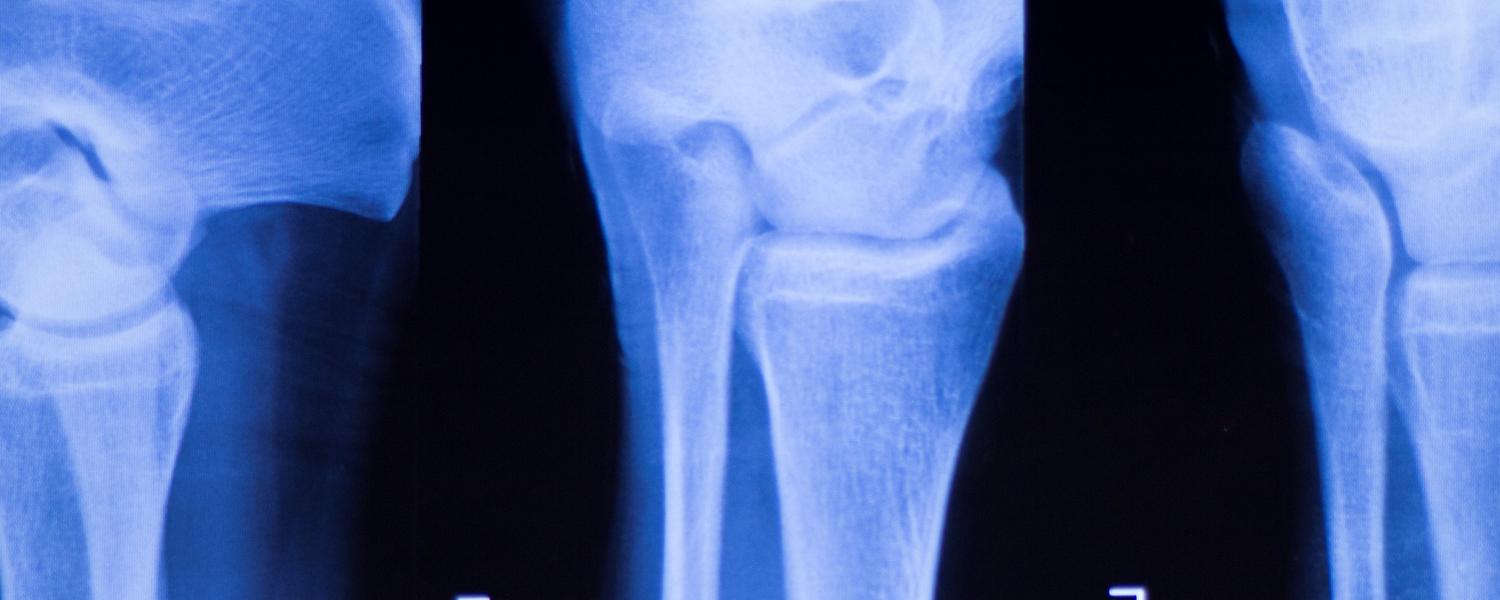 bones