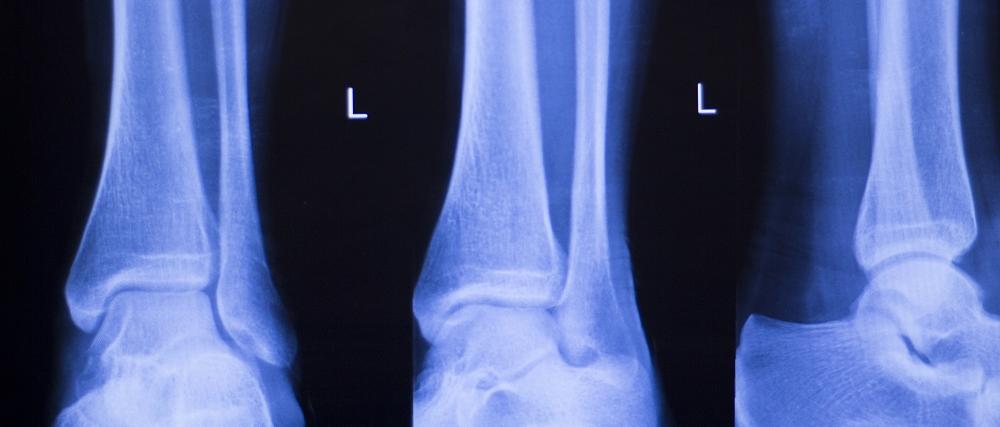 leg xrays