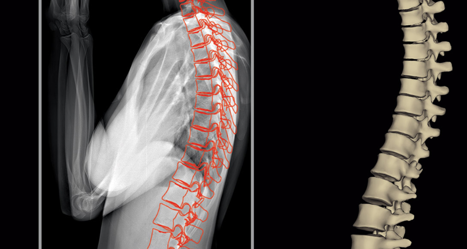 Eos spine