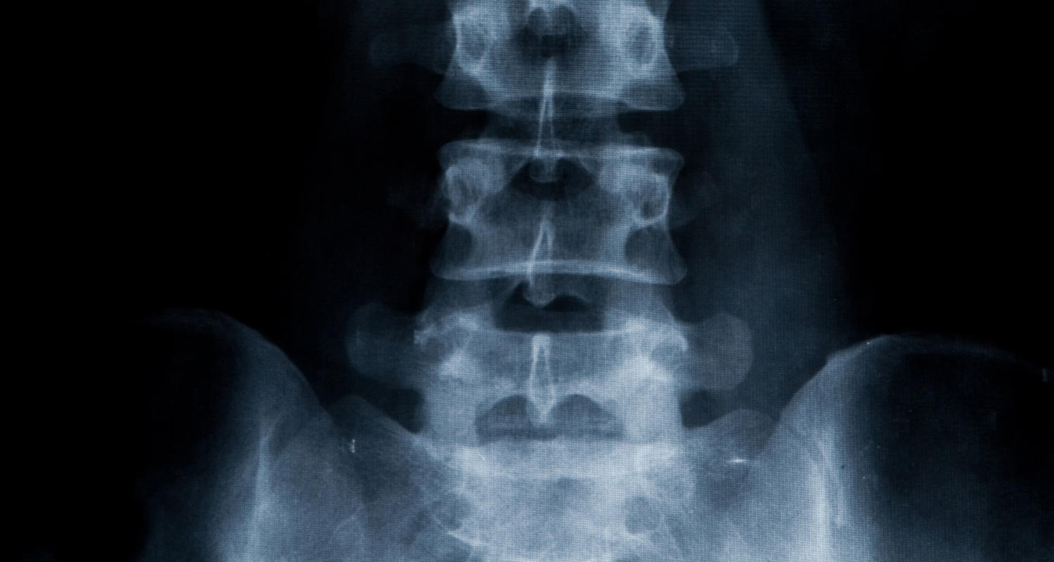 spine xray