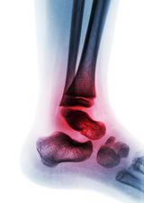 arthritic foot