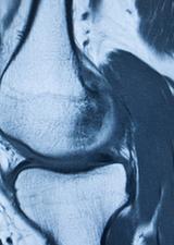 MRI knee