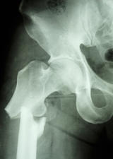 hip fracture